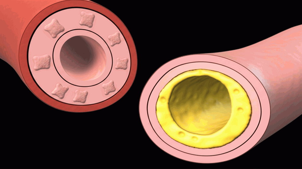 Comparison of healthy versus atherosclerotic arteries